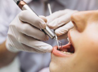 Subgingival Küretaj (Tek Diş)